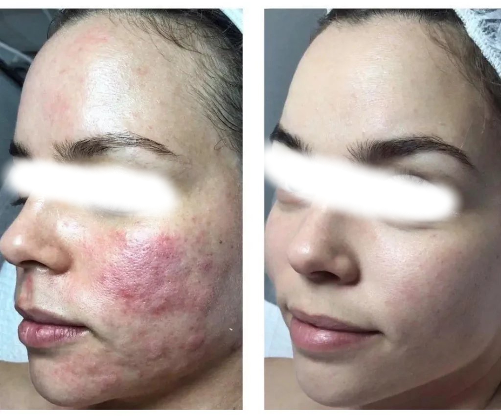 Microneedling - prima e dopo